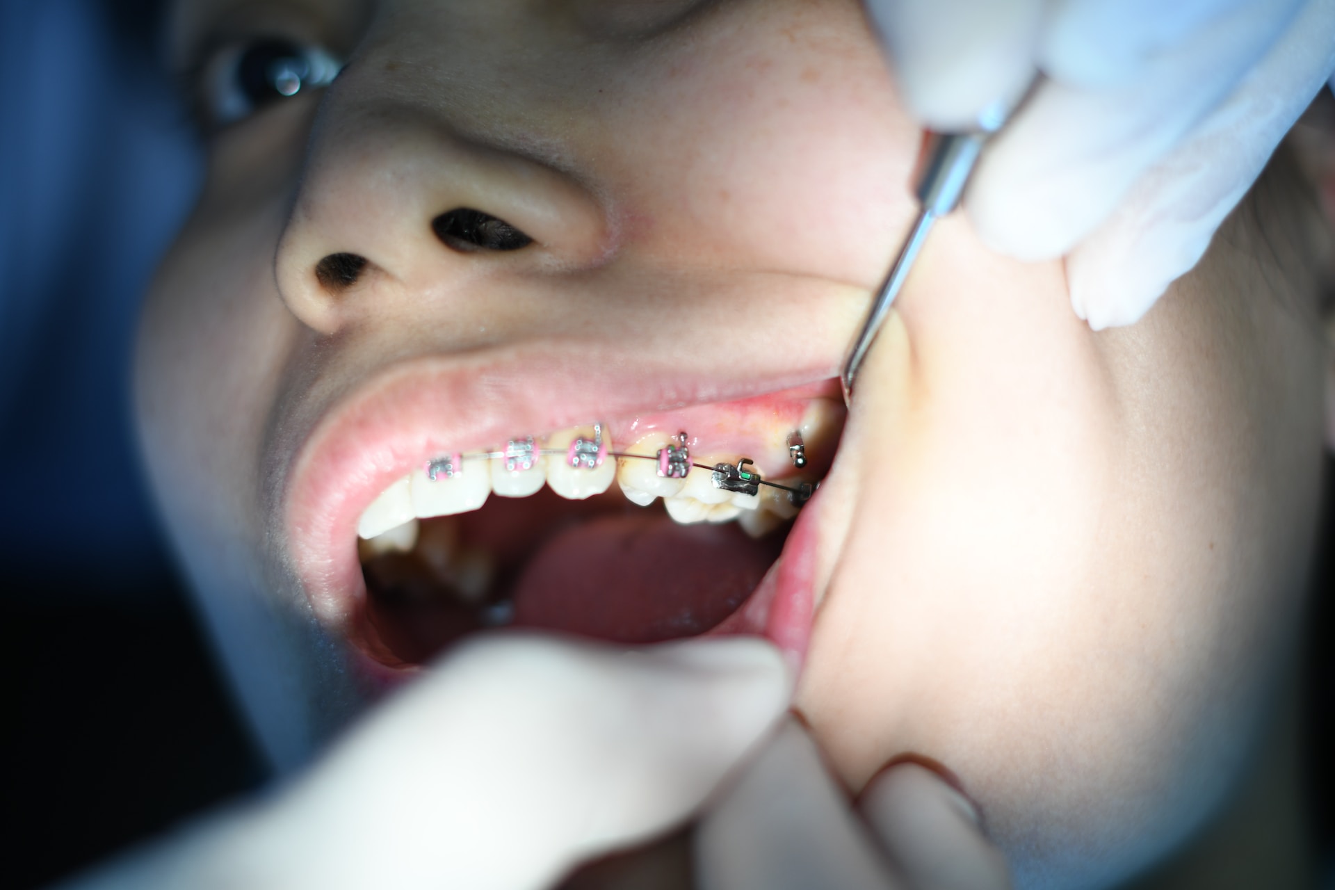 Krzywe zęby niszczą Twoją pewność siebie? Odwiedź ortodontę!